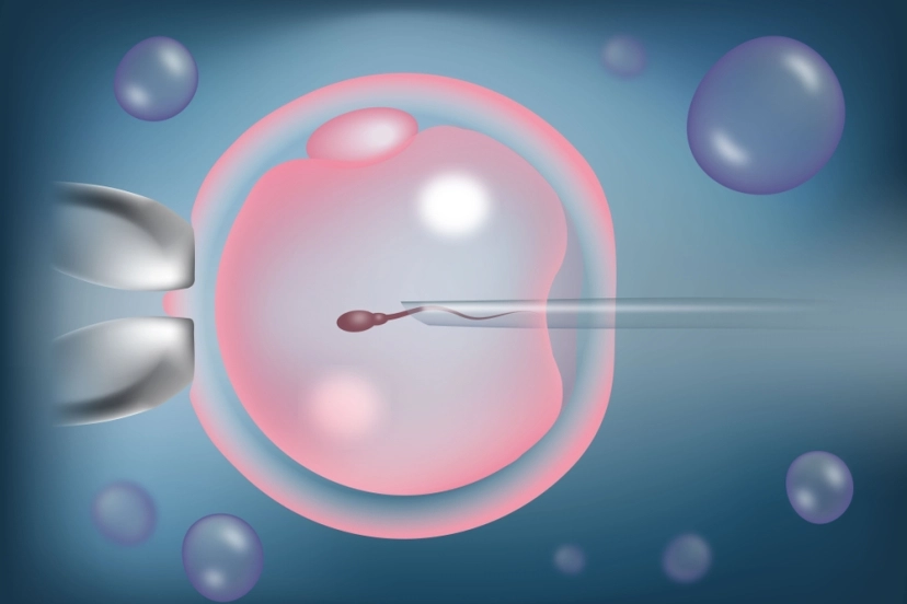 Percutaneous Epididymal Sperm Aspiration (PESA)